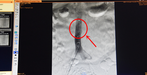 滤器取出时造影显示滤器位置正常，未发现血栓1.jpg