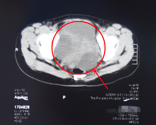术前CT显示腹部有巨大肿瘤_副本1.jpg
